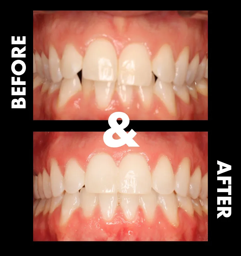 Before & After Invisalign Treatment