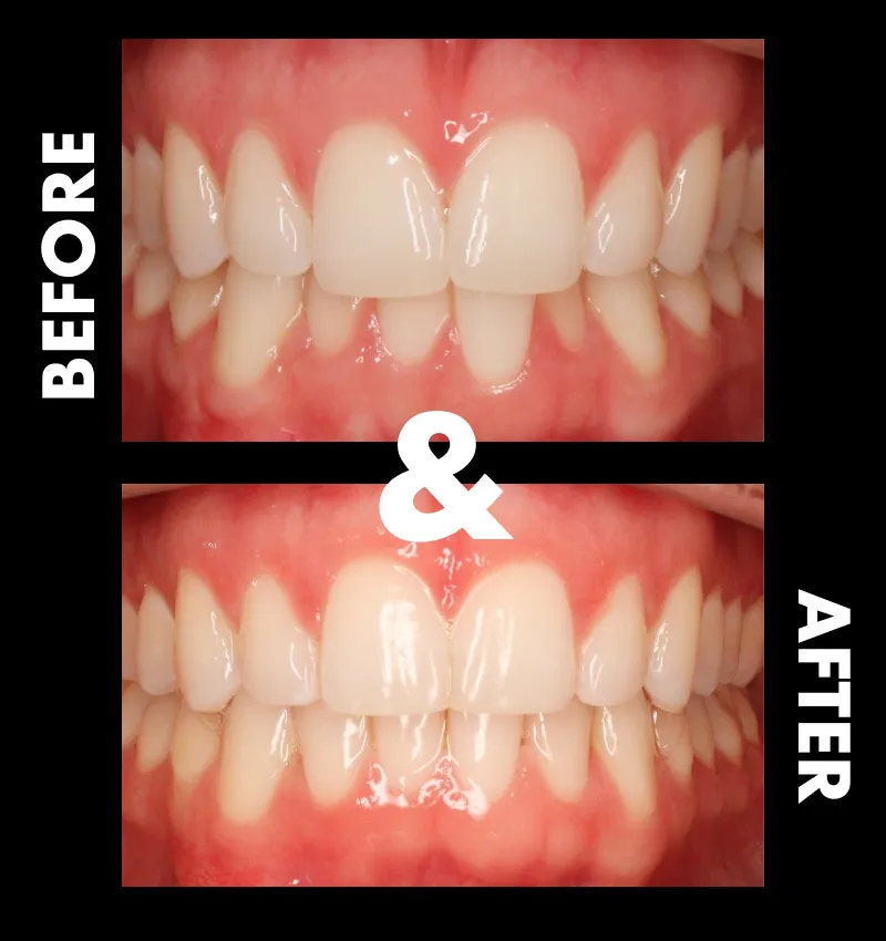 Before & After Invisalign Treatment