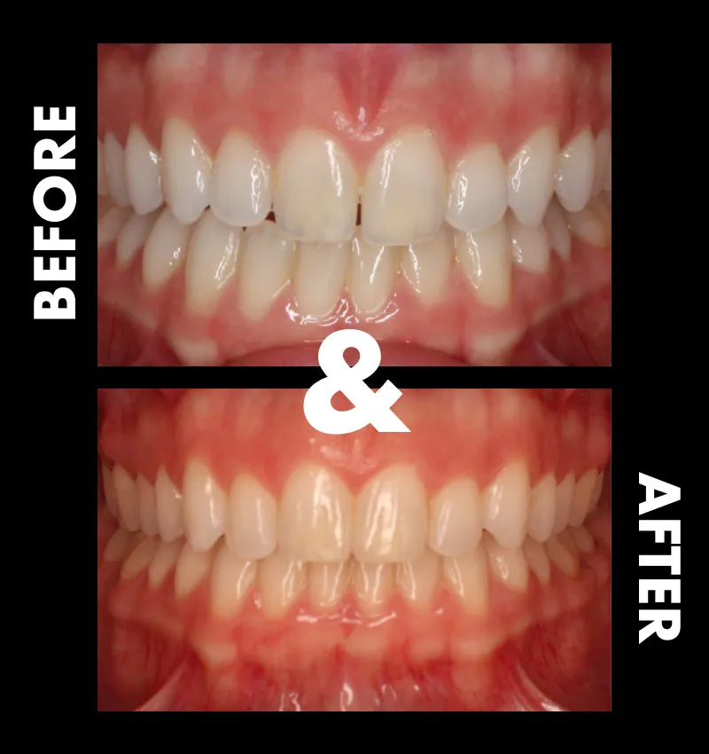 Before & After Invisalign Photos